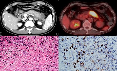 自己免疫性膵炎のCT画像(左上)、自己免疫性膵炎のPET-CT画像(右上)、自己免疫性膵炎の病理組織像(HE染色)(左下)、自己免疫性膵炎の病理組織像(IgG4染色)(右下)